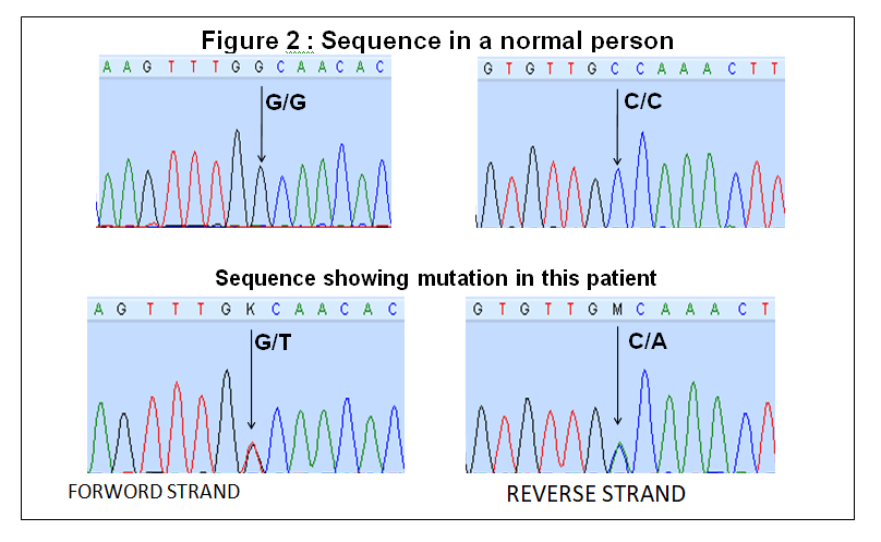 Figure 2 shows the mutation in this child causing Neonatal Diabetes 