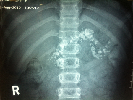 X-ray showing large pancreatic calculi