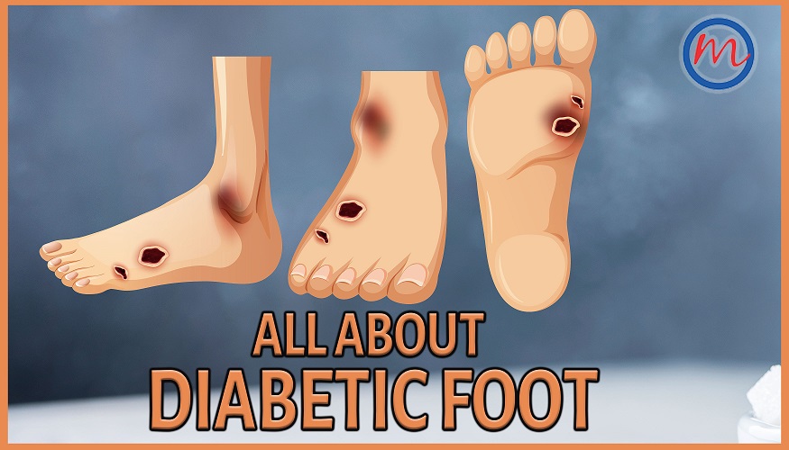 All About Diabetic Foot
